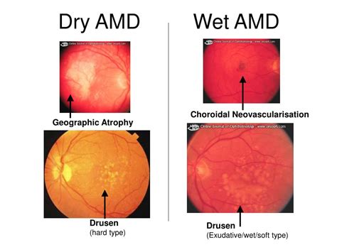 amd eye disease|wet amd signs and symptoms.